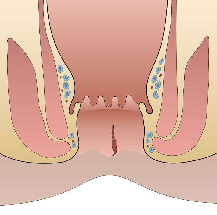 شقاق یا فیشر