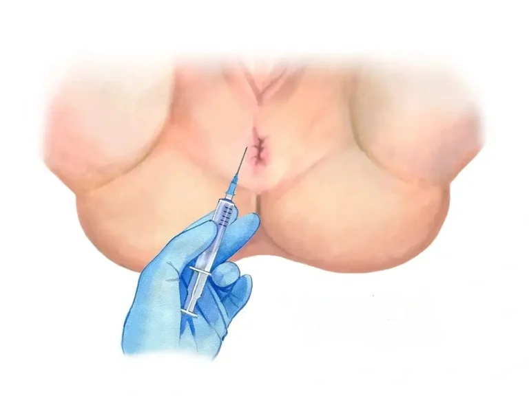 پزشک بوتاکس مقعد