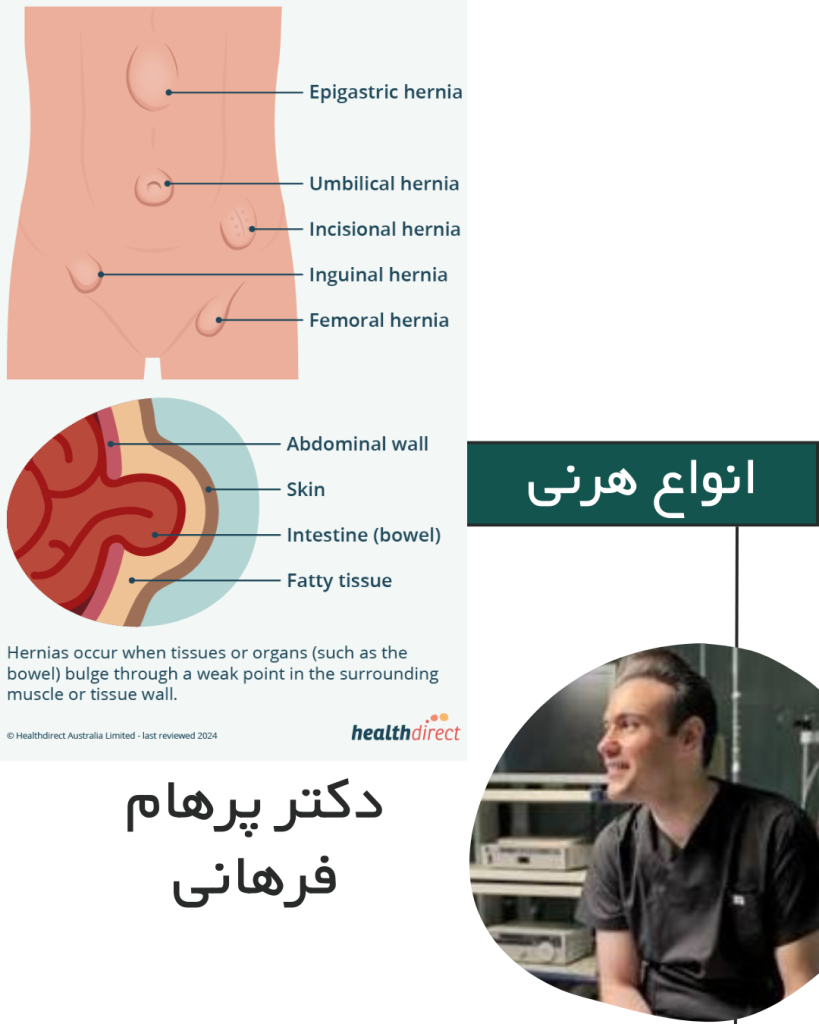 جراحی فتق اینگوینال در کرج