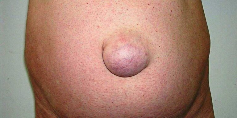 مراجعه به پزشک برای ورم فتق
