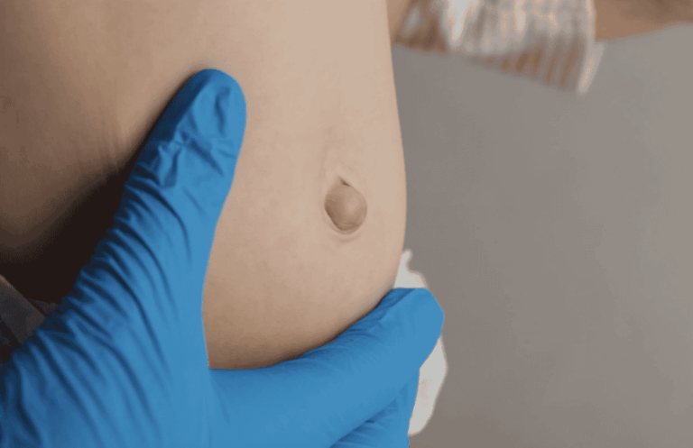 عکس فتق ناف در بزرگسالان