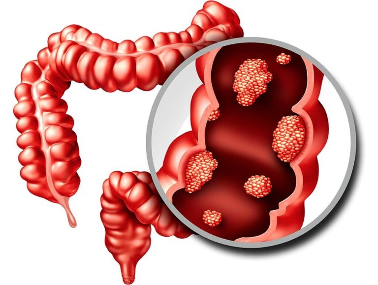 تشخیص سرطان روده