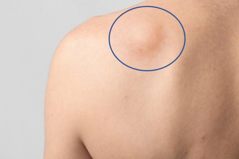 غده سرطانی در کتف