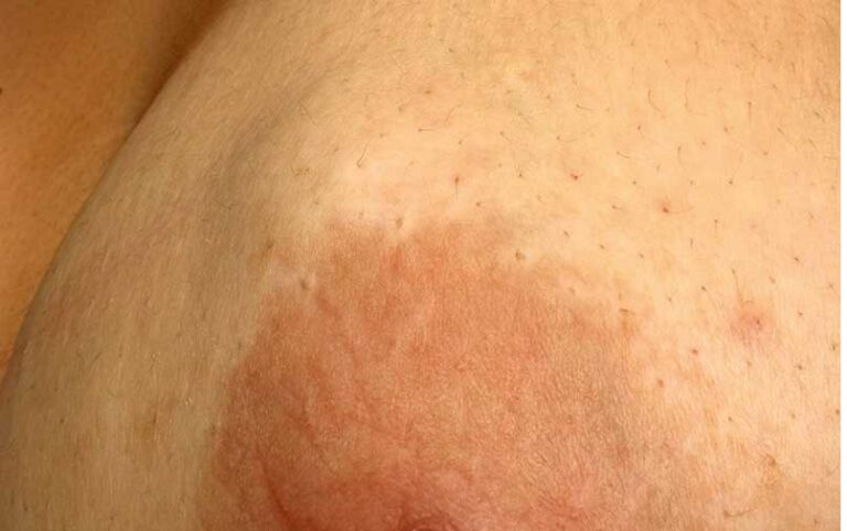 توده در سینه