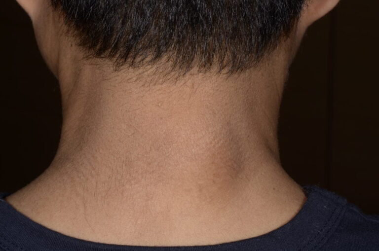 درمان غده پشت گردن