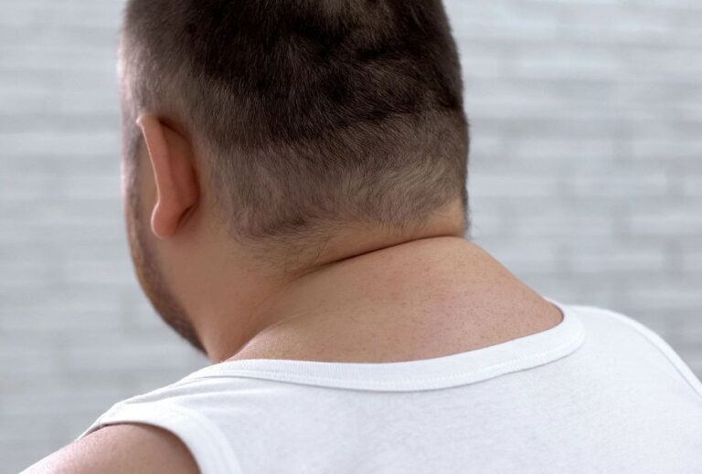 غده چربی پشت گردن (لیپوم)