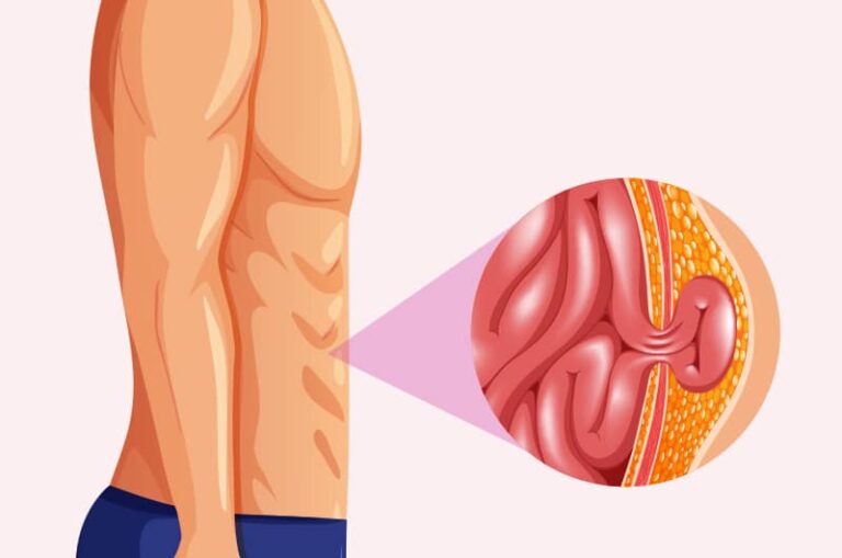 متخصص فتق ناف در شمال تهران