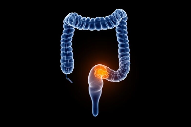 سرطان رکتوم