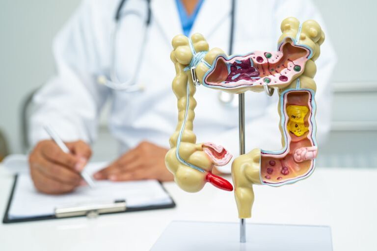 زنده ماندن در سرطان روده