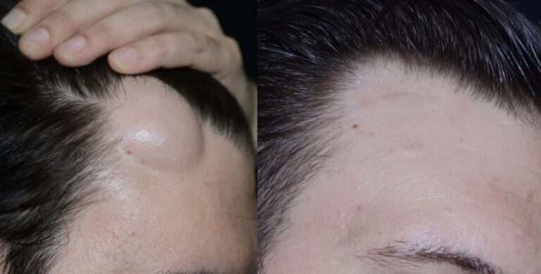 قبل و بعد جراحی غده چربی