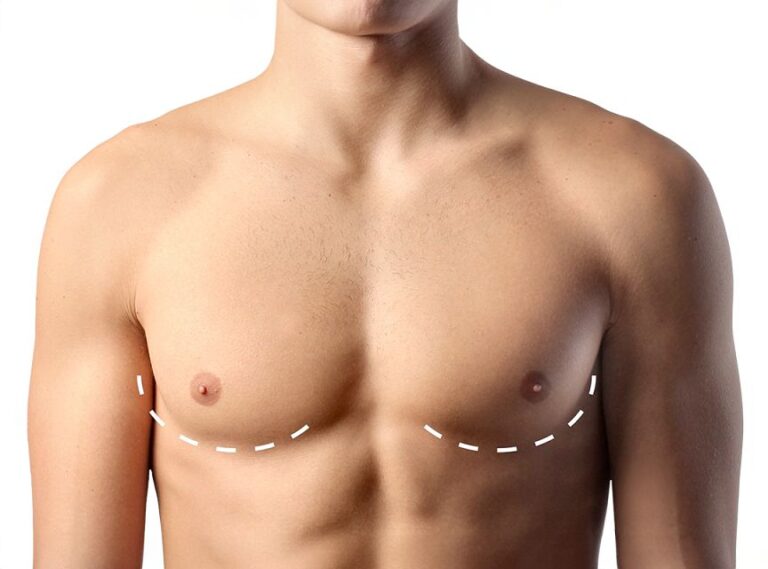 جراحی ژنیکوماستی