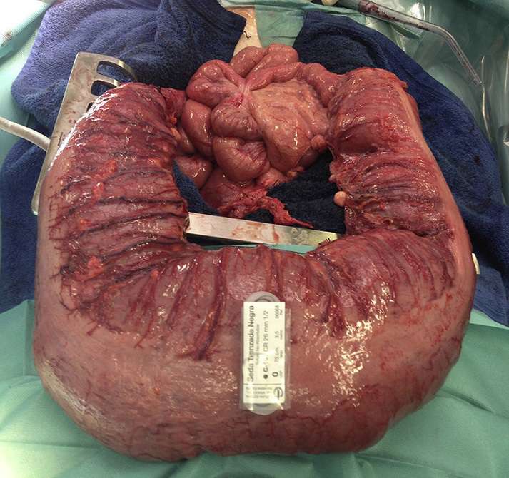 دیسپلازی روده به زبان ساده