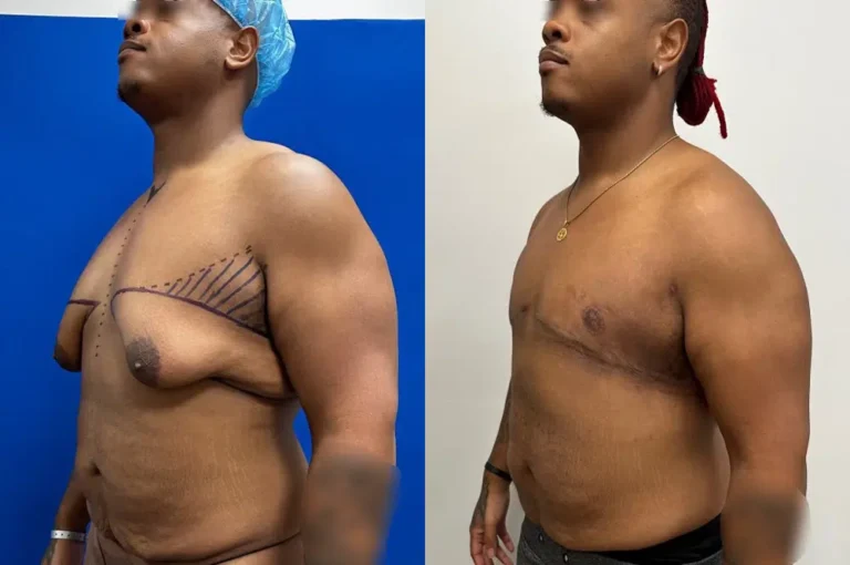 ژنیکوماستی