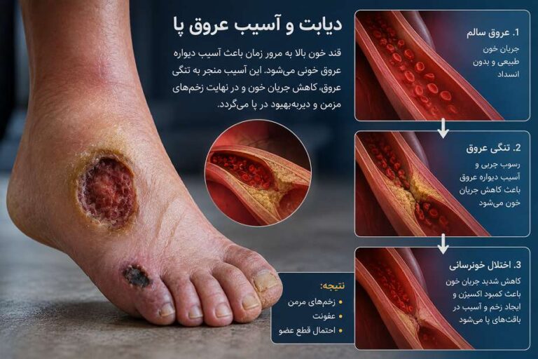 دیابت و آسیب عروق پا