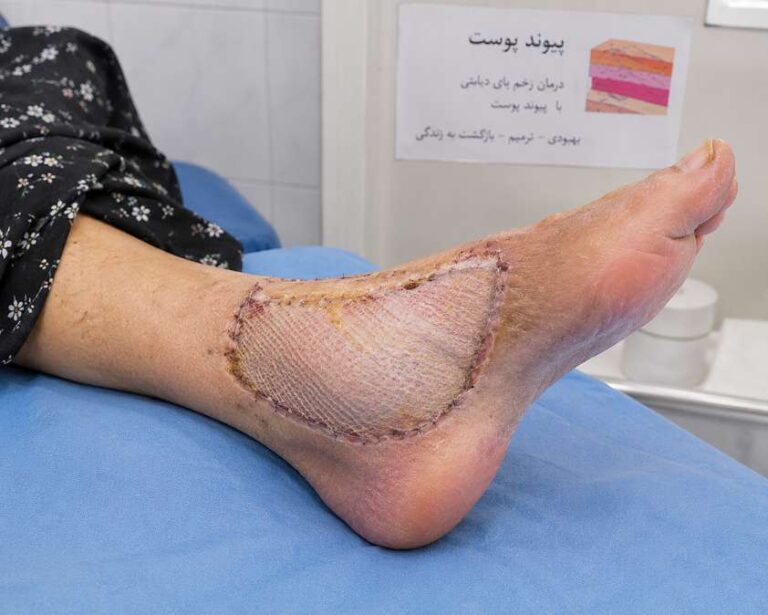 پیوند پوست در افراد دیابتی