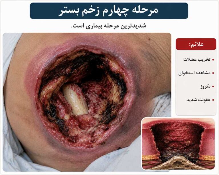 مرحله چهارم زخم بستر