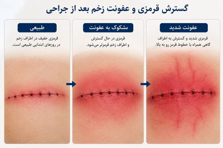 گسترش قرمزی و عفونت زخم