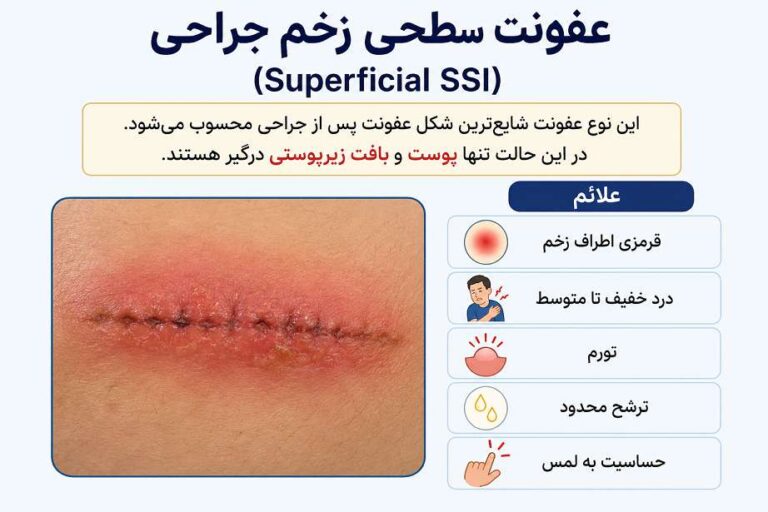 عفونت سطحی زخم جراحی