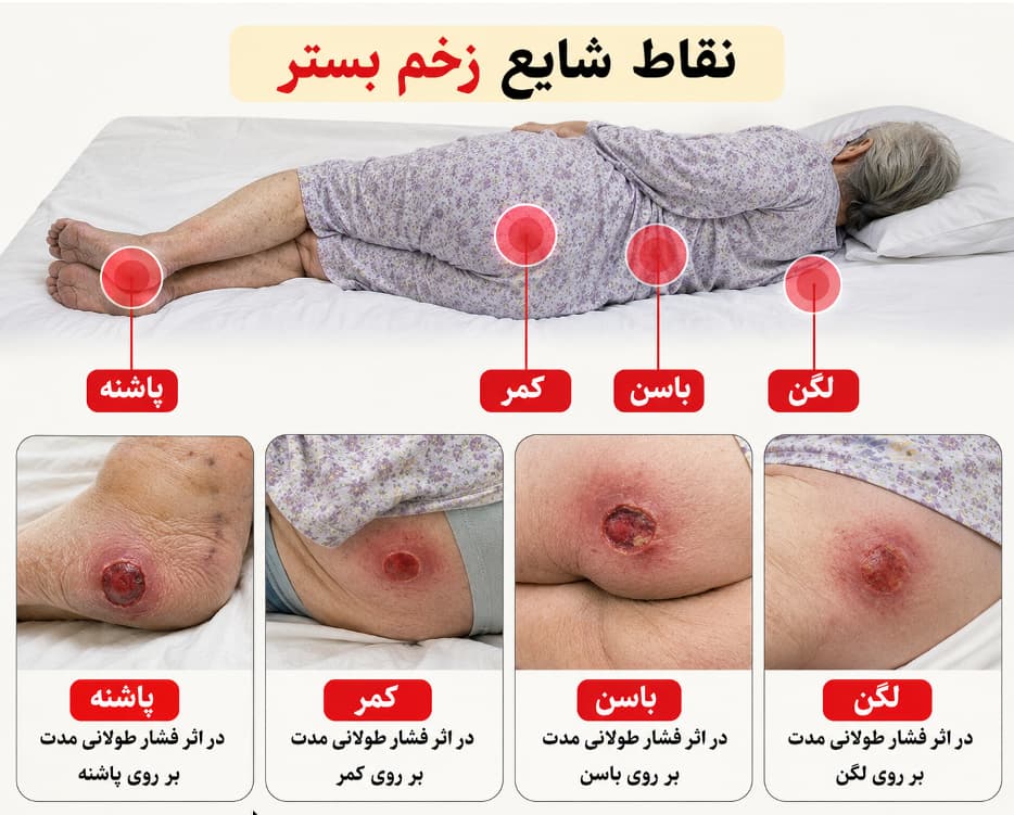 نقاط شایع زخم بستر در بدن بیماران کم‌تحرک