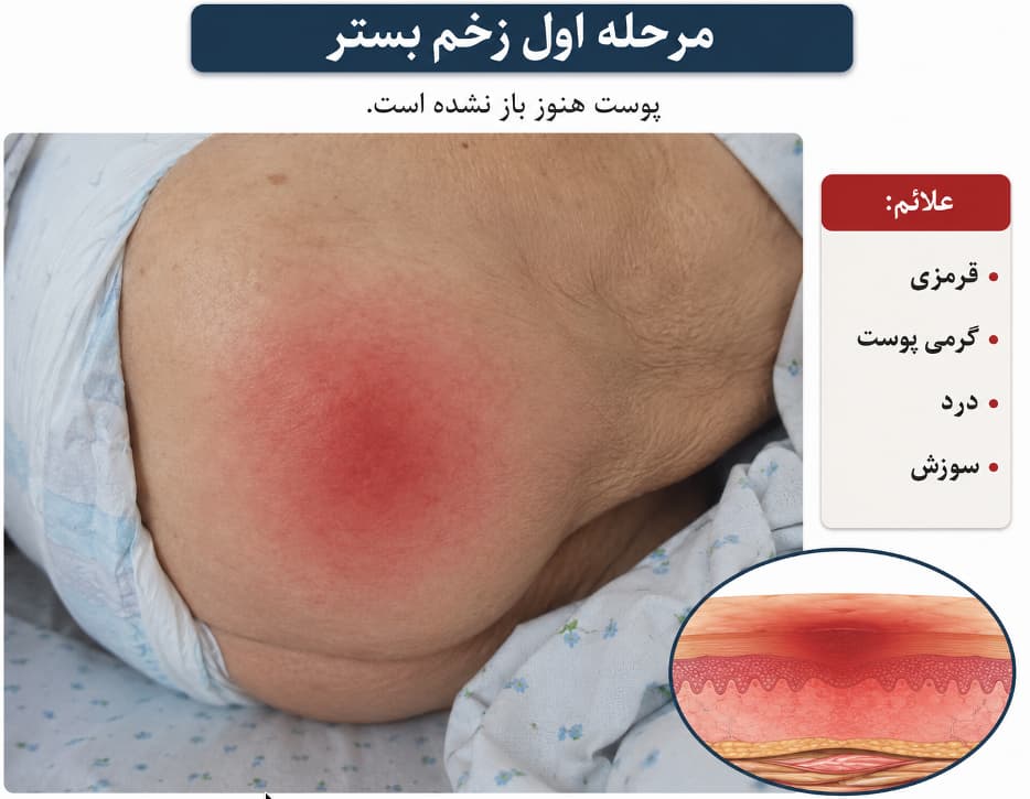 نمایش چهار مرحله پیشرفت زخم بستر روی پوست