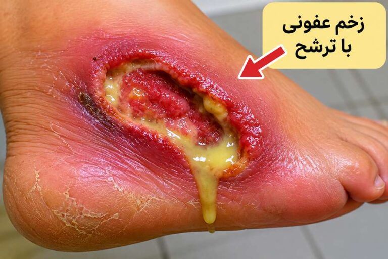 عفونت زخم